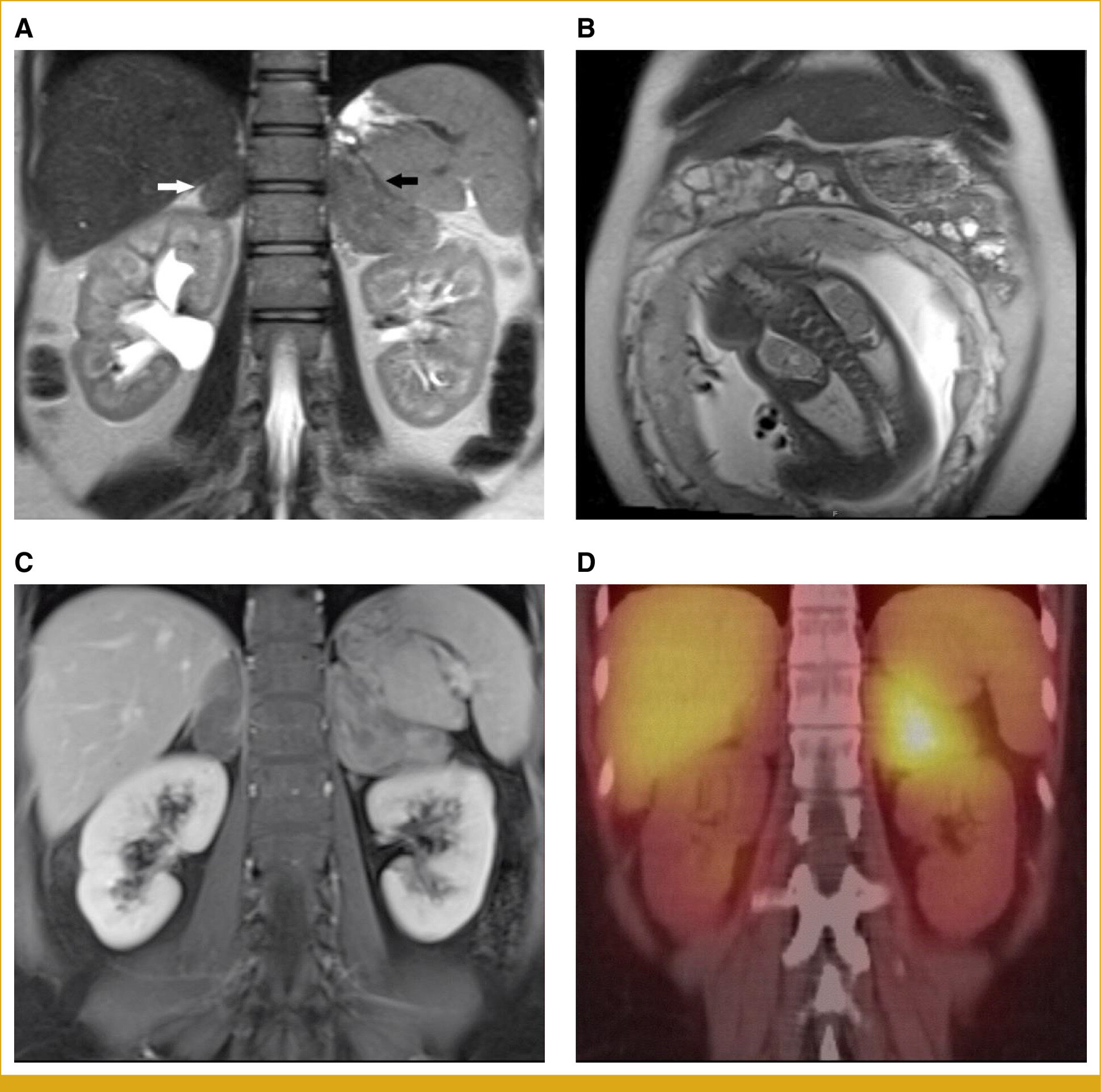 Os pesquisadores recomendam um novo padrão de atendimento para famílias com neuroblastoma hereditário ligado à mutação alk